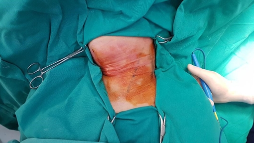 Hóc xương cá khiến nữ bệnh nhân thủng thực quản 