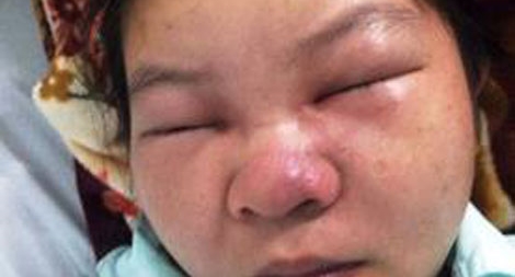 Nặn mụn, thói quen nguy hiểm chết người